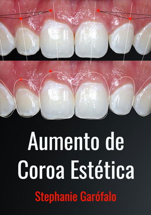 Aumento de Coroa Estética