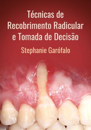Técnicas de Recobrimento Radicular e Tomada de Decisão