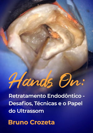 Hands on: Retratamento Endodôntico - Desafios, Técnicas e o Papel do Ultrassom