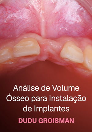 Análise de Volume Ósseo para Instalação de Implantes