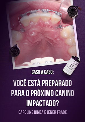Caso a Caso: Você Está Preparado para o Próximo Canino Impactado?