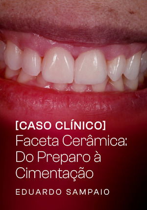 Caso Clínico - Faceta Cerâmica: do preparo à cimentação