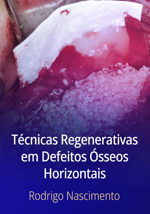 Técnicas Regenerativas em Defeitos Ósseos Horizontais