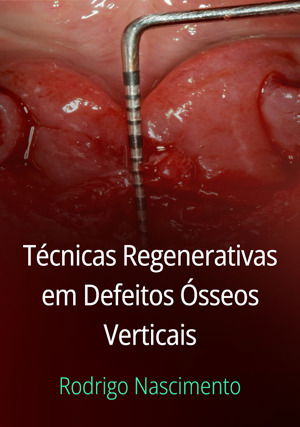 Técnicas Regenerativas em Defeitos Ósseos Verticais