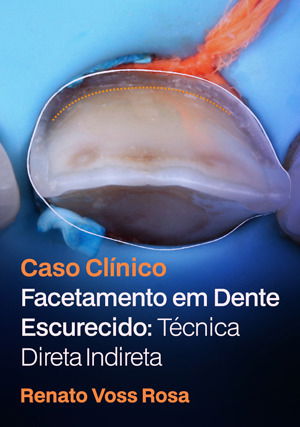 Caso Clínico: Facetamento em Dente Escurecido: Técnica Direta Indireta
