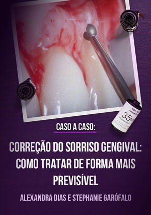 Caso a Caso -Correção do Sorriso Gengival: como tratar de forma mais previsível