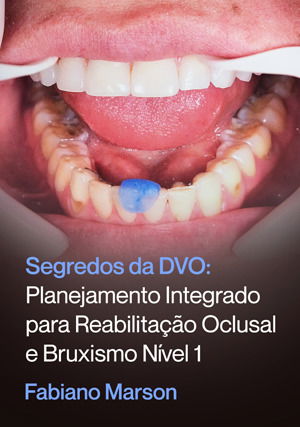 Segredos da DVO: Planejamento Integrado para Reabilitação Oclusal e Bruxismo nível 1