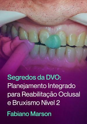 Segredos da DVO: Planejamento Integrado para Reabilitação Oclusal e Bruxismo nível 2