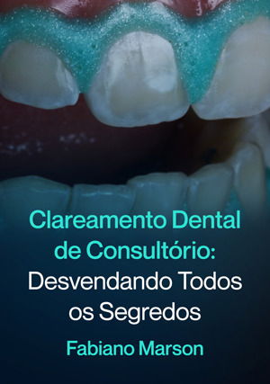 Clareamento Dental de Consultório: Desvendando Todos os Segredos
