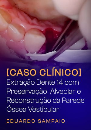 Caso Clínico: Extração Dente 14 com Preservação  Alveolar e Reconstrução da Parede Óssea Vestibular