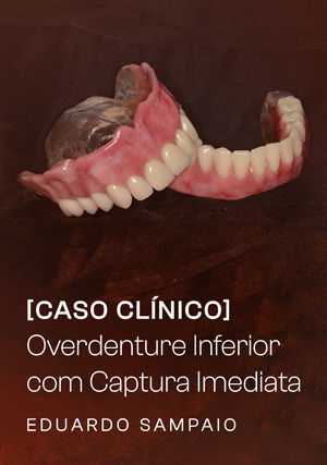 Caso Clínico: Overdenture Inferior com Captura Imediata