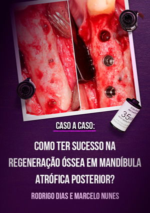 Caso a Caso: Como ter Sucesso na Regeneração Óssea em Mandíbula Atrófica Posterior?
