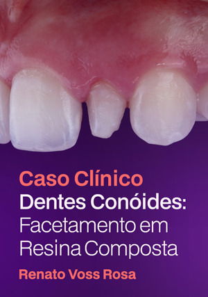 Caso Clinico: Dentes Conóides: Facetamento em Resina Composta