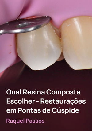 Qual Resina Composta Escolher - Restaurações em Pontas de Cúspide