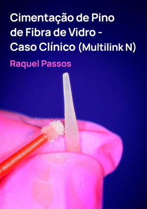 Cimentação de Pino de Fibra de Vidro - Caso Clínico (Multilink N)